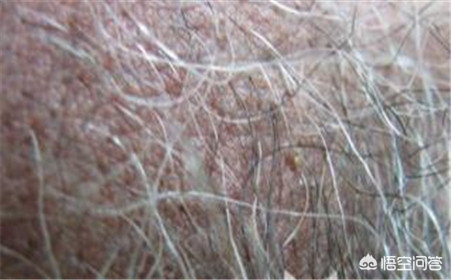 夏季多发皮肤病有哪些？什么是阴毛囊炎？