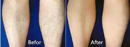 我们有没有为脱毛烦恼过,为了减肥都做过什么事