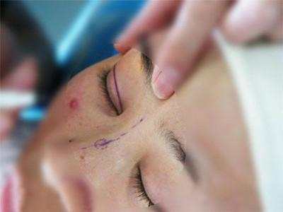 有谁做过达拉斯隆鼻,达拉斯隆鼻区别