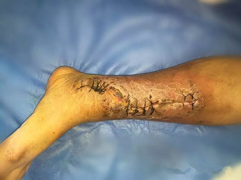 术后刀口露钢板不愈合中医疗法,术后伤口有个小洞一直不愈合