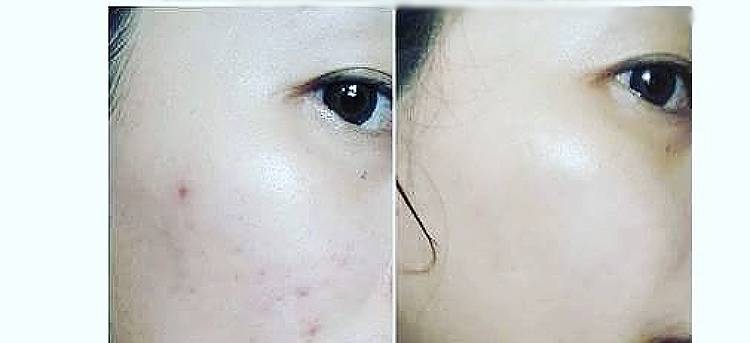 祛痘小零食,祛痘好物推荐女生专用