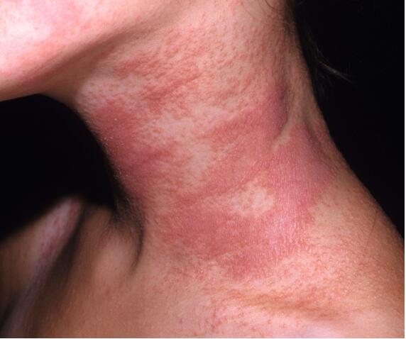 孩子湿疹最佳图片,孩子面部湿疹