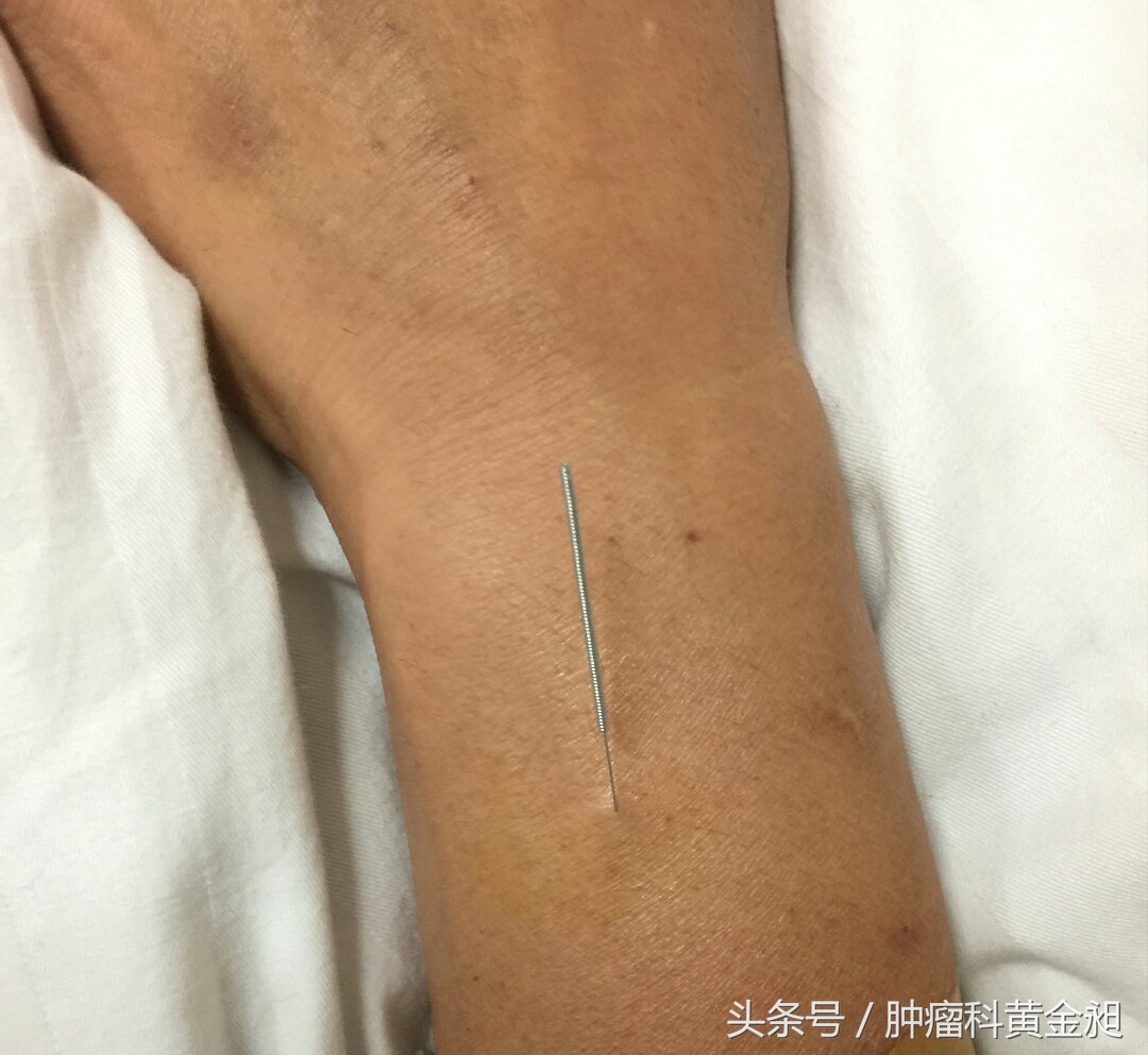 介入栓塞治疗和化疗哪个效果好,肺癌介入栓塞化疗对人的危害