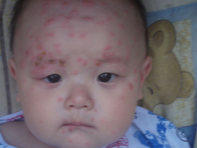 六个月宝宝感染水痘,六个月宝宝出水痘发烧了怎么办