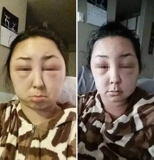 过敏的八大症状及应对方法,过敏的症状和注意事项