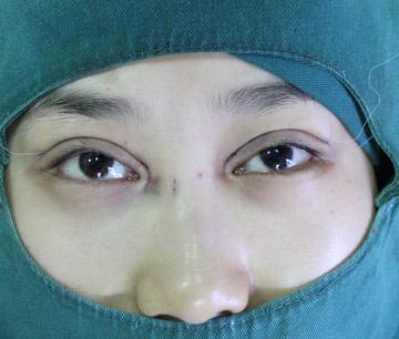 开眼角一个月还是疼,开眼角一个月还是肿需要注意什么