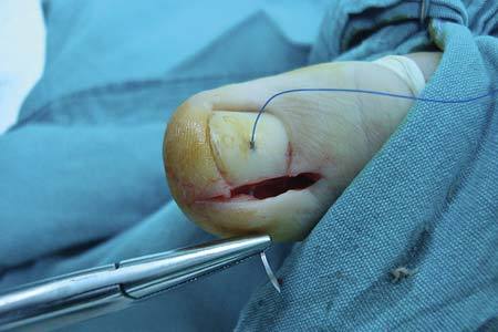 嵌甲型甲沟炎用什么药膏可以治好,治疗嵌甲甲沟炎有效的方法