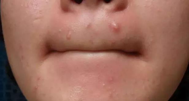 脸上长痘跟奖励有关系吗,脸上长青春痘就代表停止长高了吗