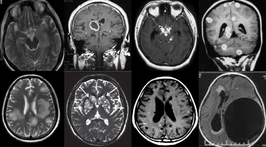 中枢神经脱髓鞘病是重大疾病吗,中枢神经系统脱髓鞘和多发性硬化