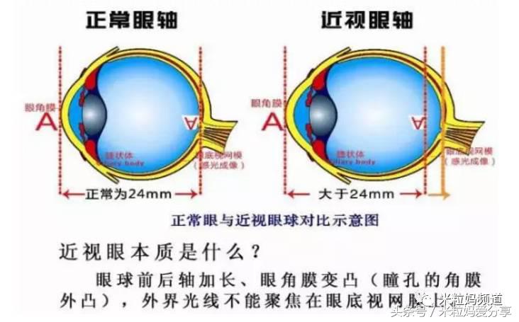 孩子100度近视如何保护视力,儿童近视300度怎么矫正视力