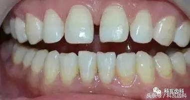 门下门牙有缝隙怎么补救,门牙开缝怎么处理最好