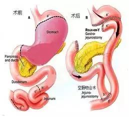 胃转流手术治疗二型糖尿病靠谱吗,郑州胃转流手术治疗糖尿病