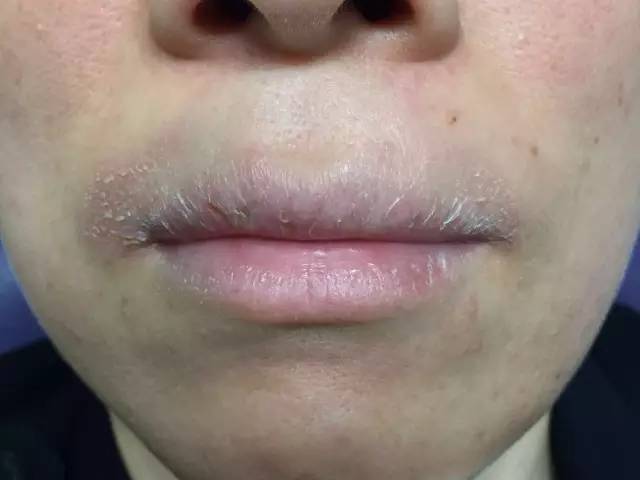 上火引起嘴唇干裂起皮用啥药,因为上火嘴唇起皮吃什么药