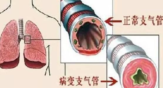 老中医治疗支气管炎秘方 (老中医治支气管炎秘方)