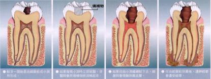 牙齿疼痛难忍补牙,牙齿根管治疗补牙后疼痛