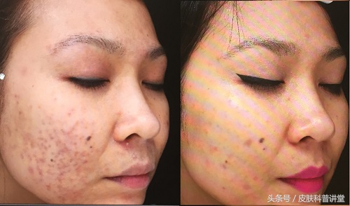 治疗疮疤中药,痔疮内服外用效果更好吗