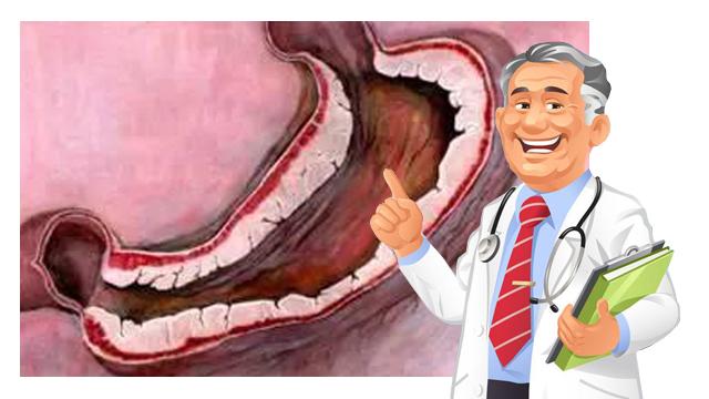 从萎缩性胃炎变成浅表性胃炎,萎缩性胃炎逆转成浅表性胃炎