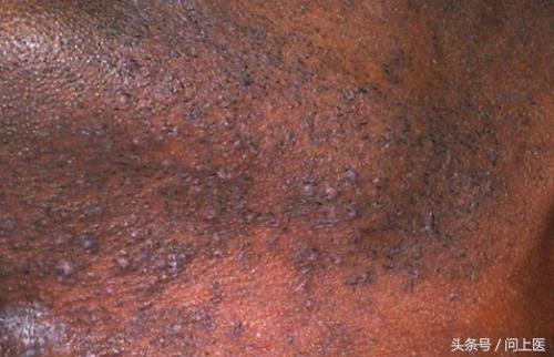 图解成年人常见的皮肤问题