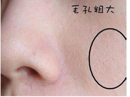 男生脸颊两侧毛孔堵塞发红,脸颊两侧毛孔变大的原因是什么