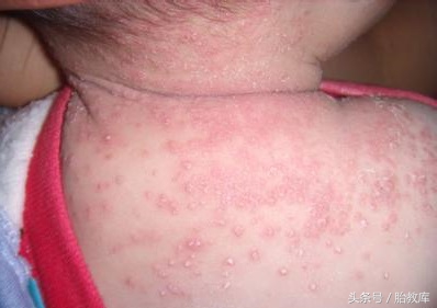 婴儿湿疹要用什么方法去预防,婴儿湿疹怎么避免和预防