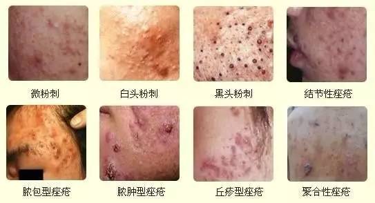 闭合性粉刺爆浆,闭合性粉刺还有痘印