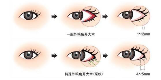 开外眼角是红的怎么回事,什么适合开外眼角