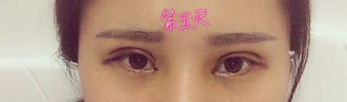 内双可以做埋线双眼皮整个过程,内双做埋线双眼皮会变成三眼皮吗