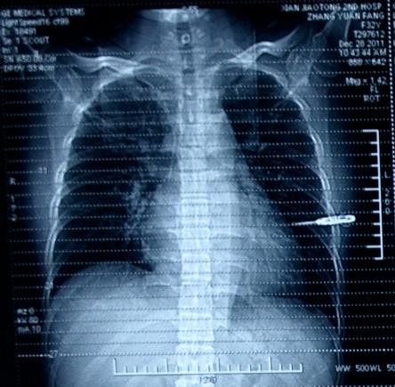 酒精中毒引起的末梢神经炎怎么治,酒精中毒要怎么治