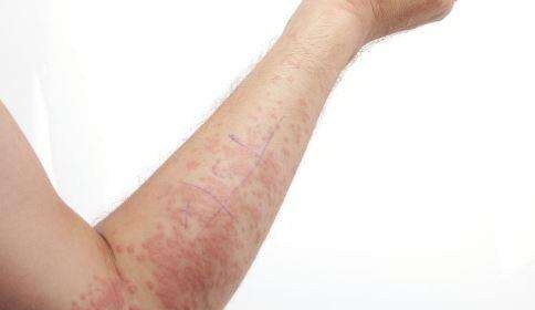 湿疹奇痒难忍怎么治疗,湿疹反复发作奇痒中医给两种方法