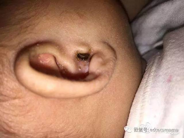 耳朵有黄色分泌物感觉堵住了一样,宝宝耳朵里有黄色分泌物能清理不