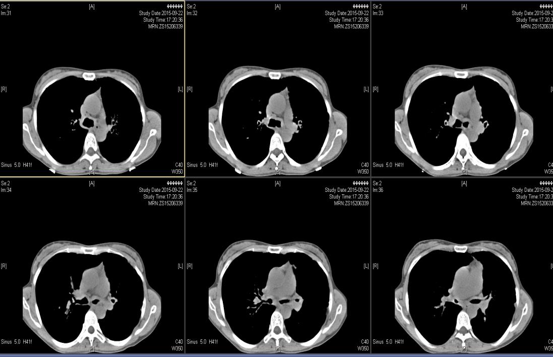 反复咳嗽咳痰气喘5年,长期咳嗽气短久治不愈的原因