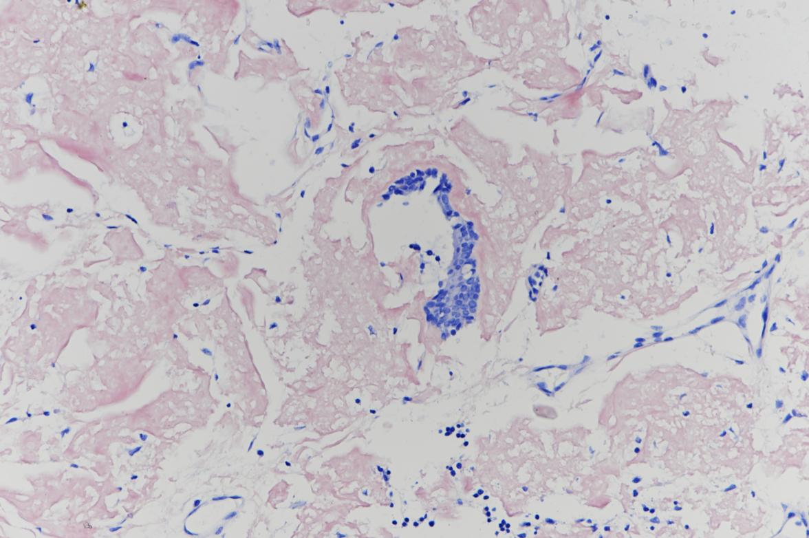 反复咳嗽咳痰气喘5年,长期咳嗽气短久治不愈的原因