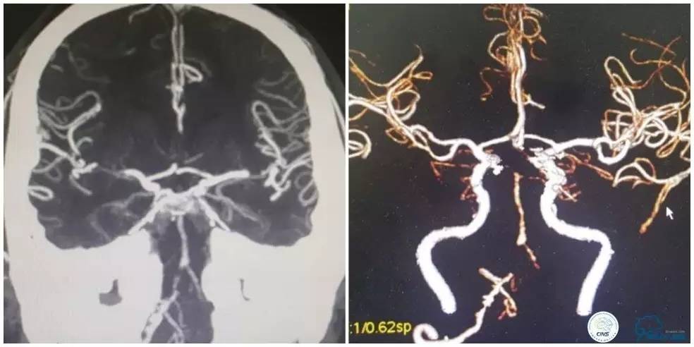 天坛周记|右椎动脉V1段及V4-基底动脉串联病变支架治疗一例