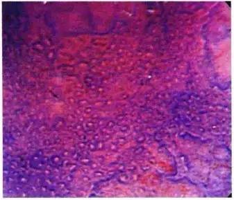 普通内镜与Pitpattern分型（多图详解）