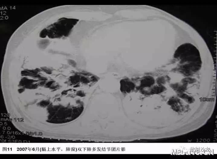 双肺实性小结节考虑炎症肉芽肿,双肺多发恶性肺结节100多个