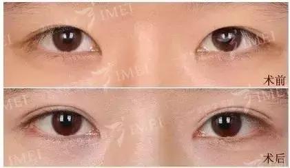 割一个双眼皮去哪做修复,修复3000块的双眼皮你敢做吗