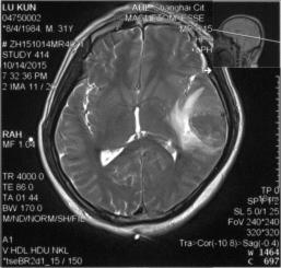 颅内静脉窦血栓怎么治疗,颅内静脉窦血栓造影多少钱