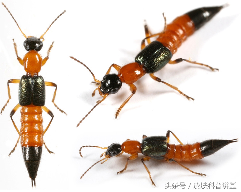 隐翅虫皮炎部位睡觉需要避开吗,晚上睡觉怎么避免隐翅虫