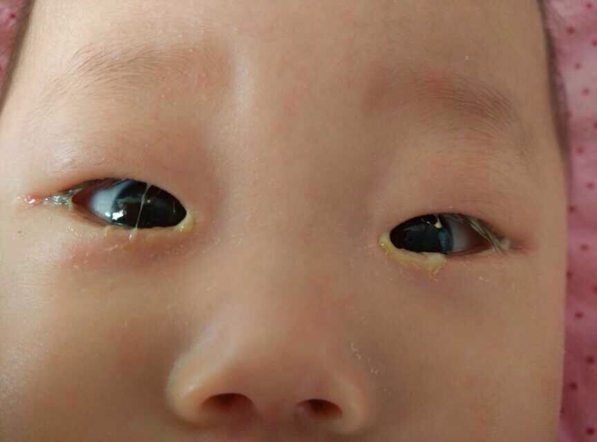 宝宝眼睛老是红血丝怎么回事,宝宝眼睛总是红流泪怎么回事
