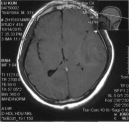颅内静脉窦血栓怎么治疗,颅内静脉窦血栓造影多少钱