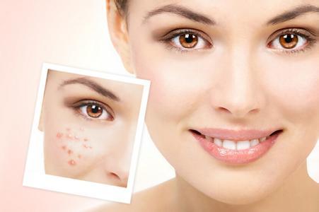 脸颊两侧泛红长痘痘,脸颊两侧长痘痘怎么治