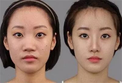 鼻部整形有哪些注意事项,鼻部整形一个月内能做剧烈运动吗