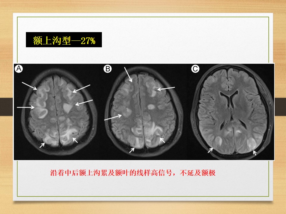 可逆性后部白质脑病综合征中央型,可逆性后部白质脑病综合征啥症状