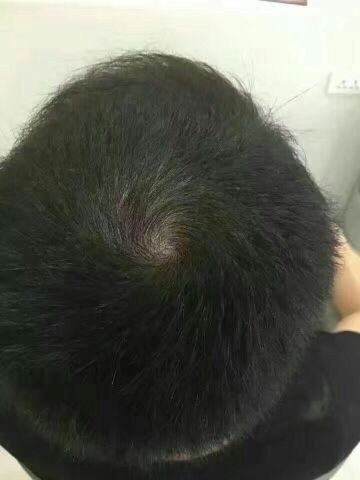 沙溢秃顶电视剧,沙溢秃顶