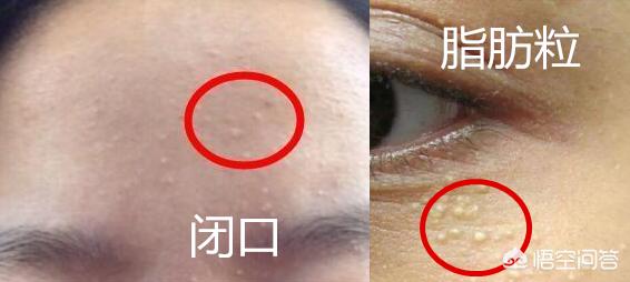 护肤为什么会长闭口,护肤为何毛孔变大脱皮