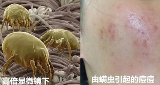 脸上螨虫感染皮肤怎么治疗快,脸上螨虫怎么消除最快方法