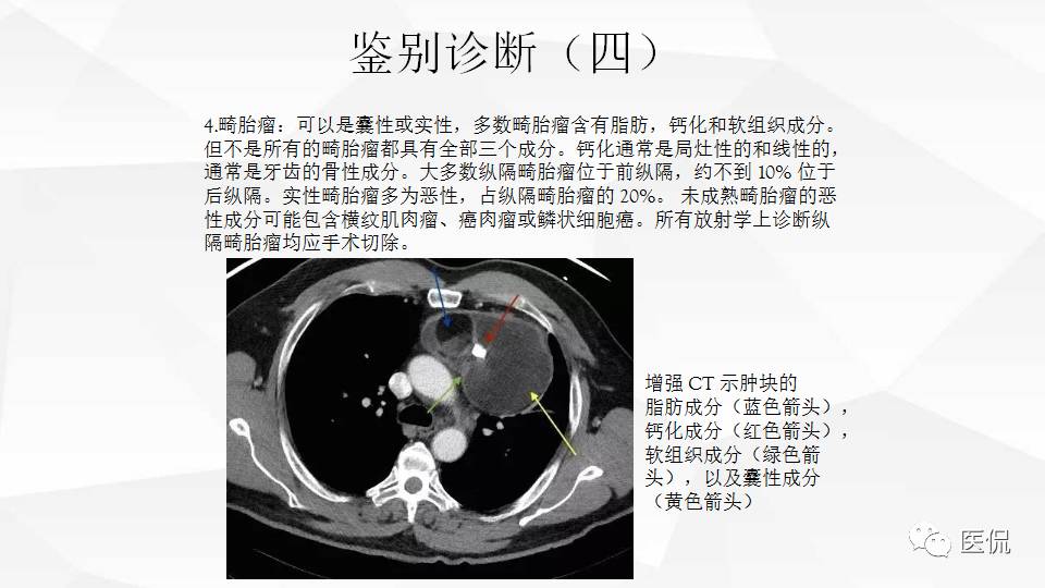 精原细胞瘤ct影像,精原细胞瘤影像特征