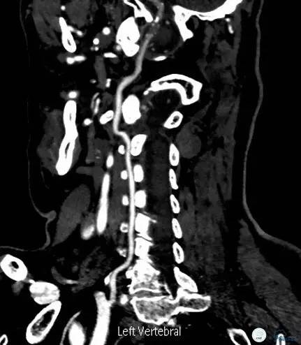 椎动脉狭窄支架植入术需要多少钱,颅内动脉狭窄支架手术后哪些症状