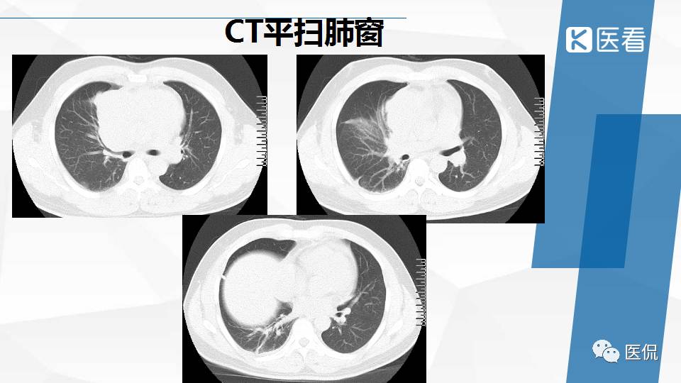 精原细胞瘤ct影像,精原细胞瘤影像特征
