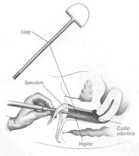 宫颈高度病变镜下观察,宫颈镜下可疑浸润癌严重吗